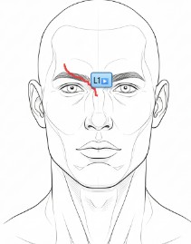 Laceration drawn on anatomical head diagram